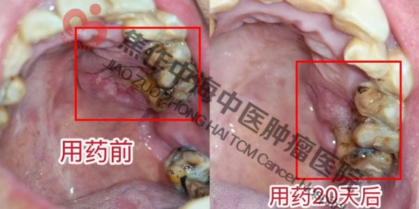 1786094111216706.jpg 上颚癌杨梅.jpg