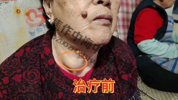 1786096266642952.jpg 淋巴瘤常秀梅2.jpg