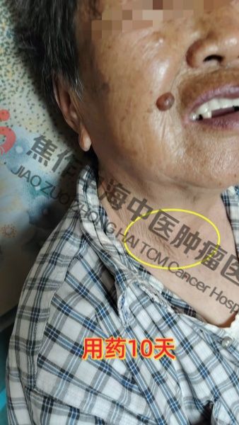 1786096283412987.jpg 淋巴瘤常秀梅3.jpg