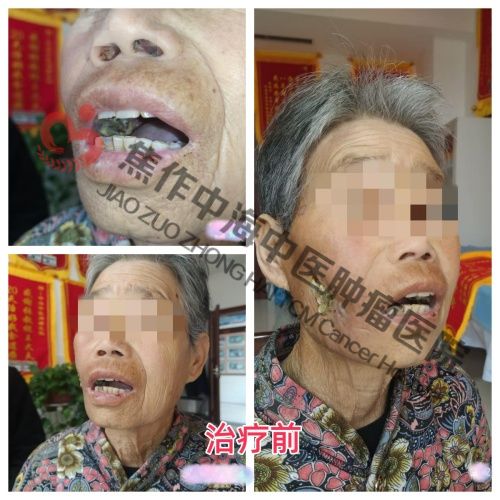 1786096591121193.jpg 口腔癌谷凤琴2.jpg