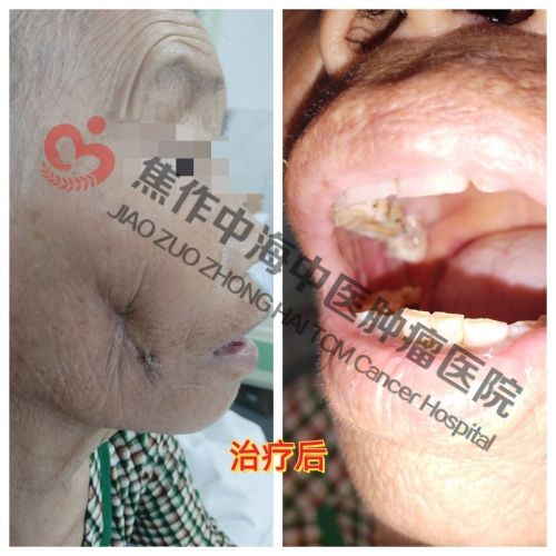 1786096608889619.jpg 口腔癌谷凤琴3.jpg