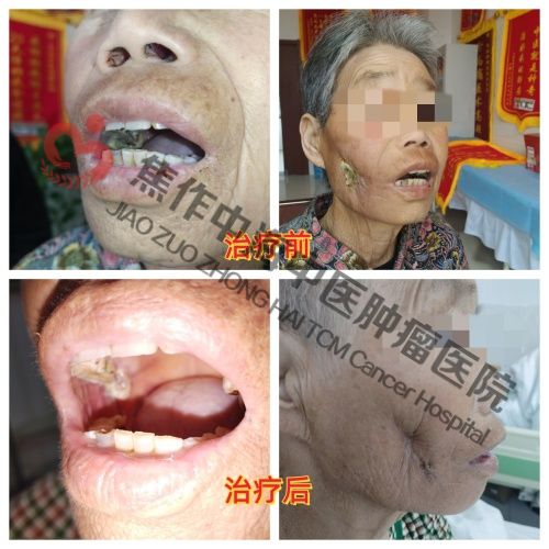 1786096626175274.jpg 口腔癌谷凤琴4.jpg