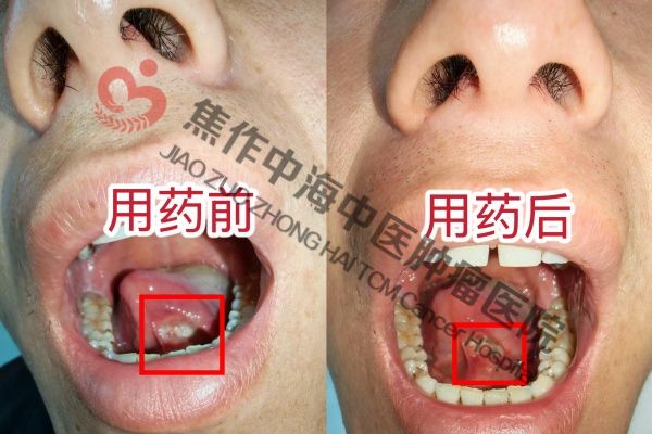 舌癌赵天宝.jpg