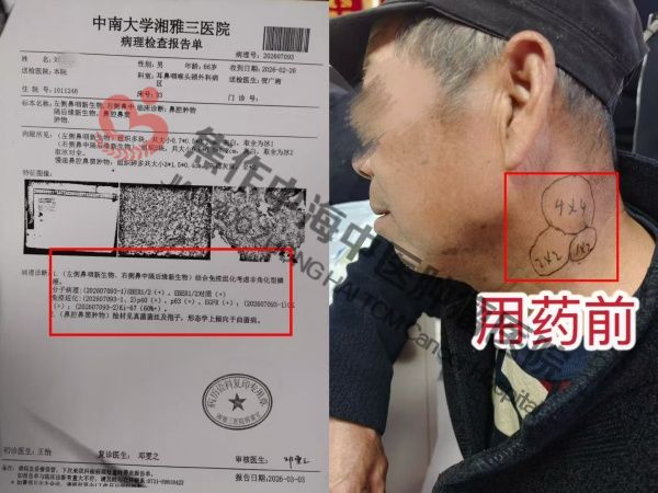 鼻咽癌刘跃耕1.jpg