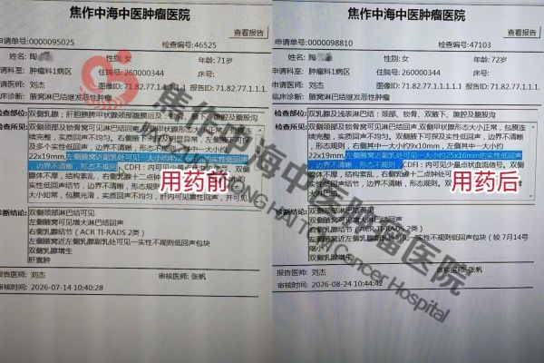 1788596292132001.jpg 腋窝癌陶小英.jpg
