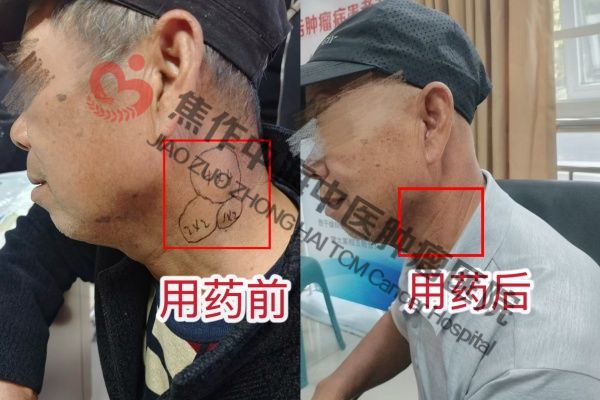 1790148227835176.jpg 鼻咽癌刘跃耕.jpg