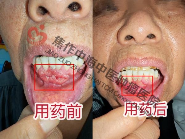1791444033757235.jpg 牙龈癌程春娥.jpg