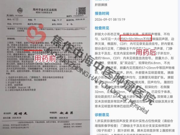 1792395896591650.jpg 肝癌杨小国.jpg